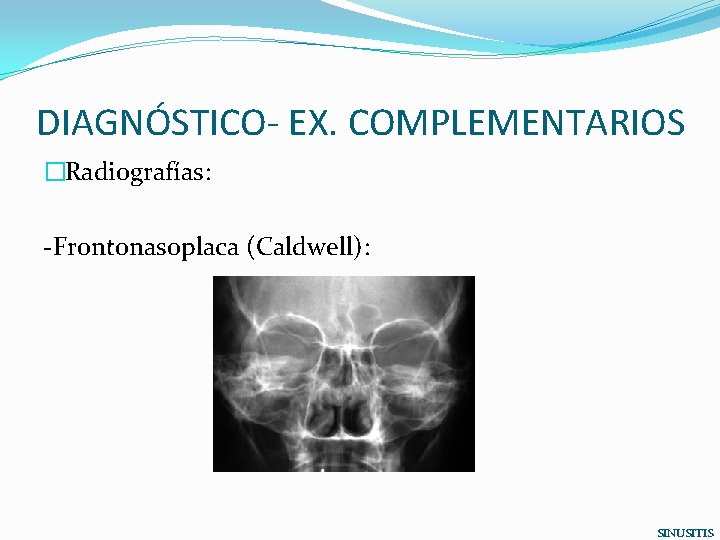 DIAGNÓSTICO- EX. COMPLEMENTARIOS �Radiografías: -Frontonasoplaca (Caldwell): SINUSITIS 
