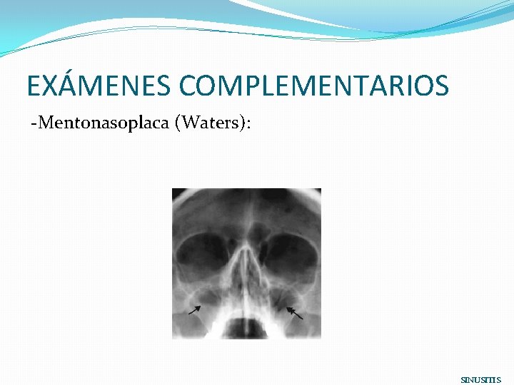EXÁMENES COMPLEMENTARIOS -Mentonasoplaca (Waters): SINUSITIS 