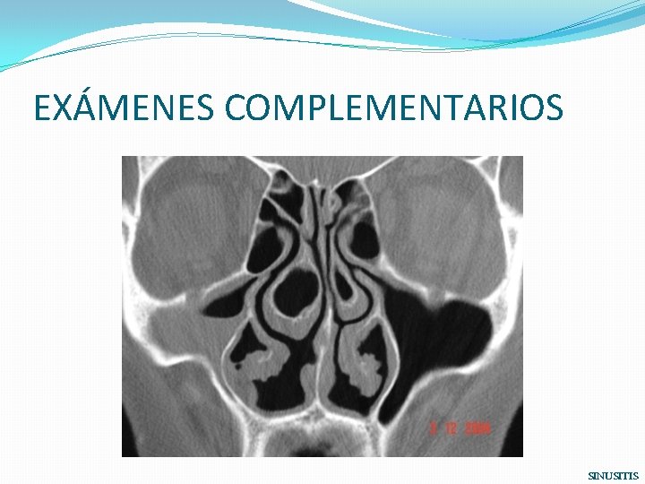 EXÁMENES COMPLEMENTARIOS SINUSITIS 