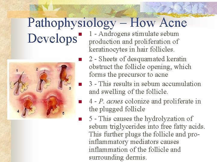 Pathophysiology – How Acne n 1 - Androgens stimulate sebum Develops production and proliferation