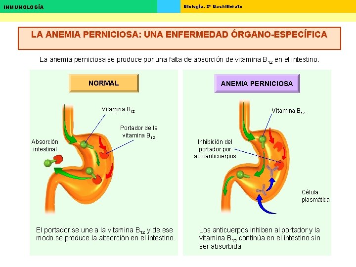 Biología. 2º Bachillerato INMUNOLOGÍA LA ANEMIA PERNICIOSA: UNA ENFERMEDAD ÓRGANO-ESPECÍFICA La anemia perniciosa se Biología. 2º Bachillerato INMUNOLOGÍA LA ANEMIA PERNICIOSA: UNA ENFERMEDAD ÓRGANO-ESPECÍFICA La anemia perniciosa se