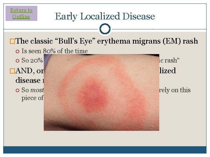 Return to Outline Early Localized Disease �The classic “Bull’s Eye” erythema migrans (EM) rash