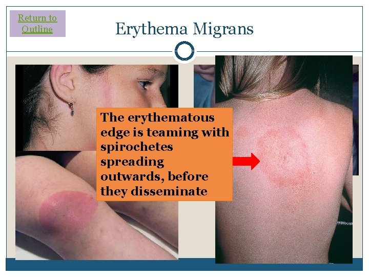 Return to Outline Erythema Migrans The erythematous edge is teaming with spirochetes spreading outwards,