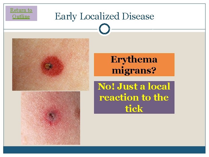 Return to Outline Early Localized Disease Erythema migrans? No! Just a local reaction to