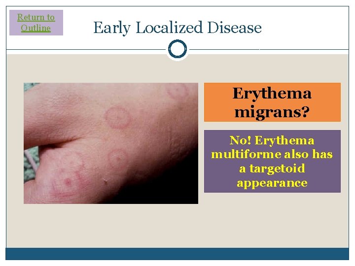 Return to Outline Early Localized Disease Erythema migrans? No! Erythema multiforme also has a