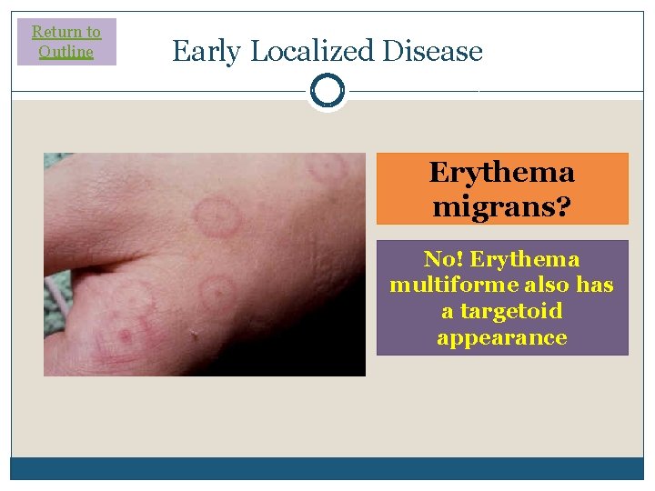 Return to Outline Early Localized Disease Erythema migrans? No! Erythema multiforme also has a Return to Outline Early Localized Disease Erythema migrans? No! Erythema multiforme also has a