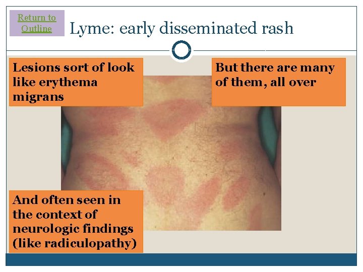 Return to Outline Lyme: early disseminated rash Lesions sort of look like erythema migrans