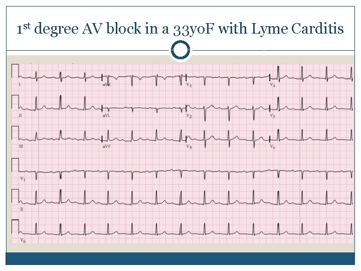 1 st degree AV block in a 33 yo. F with Lyme Carditis 