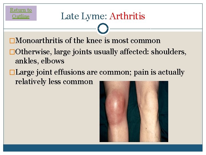 Return to Outline Late Lyme: Arthritis �Monoarthritis of the knee is most common �Otherwise,