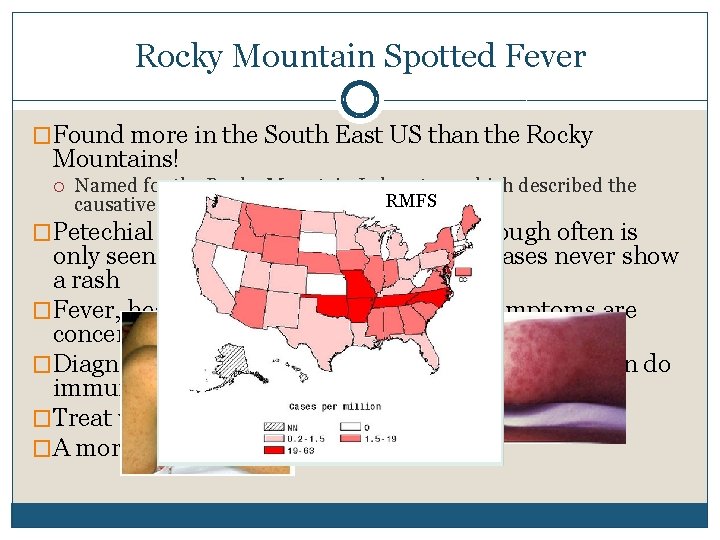 Rocky Mountain Spotted Fever �Found more in the South East US than the Rocky Rocky Mountain Spotted Fever �Found more in the South East US than the Rocky
