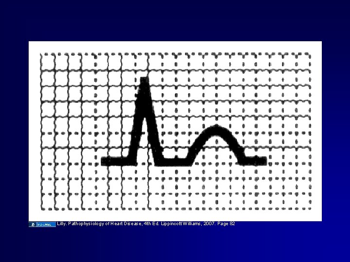Lilly. Pathophysiology of Heart Disease, 4 th Ed. Lippincott Williams, 2007. Page 82 