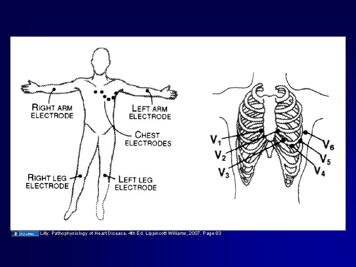 Lilly. Pathophysiology of Heart Disease, 4 th Ed. Lippincott Williams, 2007. Page 83 