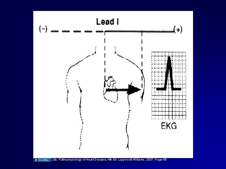 Lilly. Pathophysiology of Heart Disease, 4 th Ed. Lippincott Williams, 2007. Page 85 