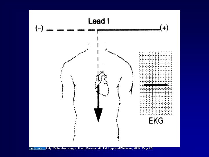 Lilly. Pathophysiology of Heart Disease, 4 th Ed. Lippincott Williams, 2007. Page 85 