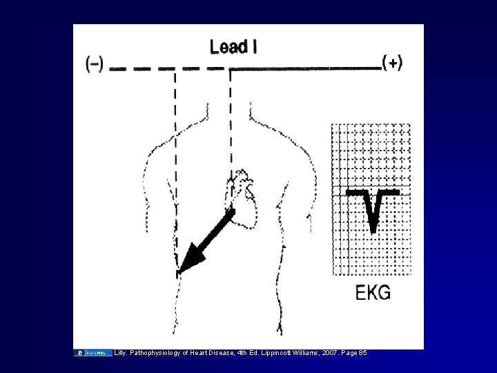 Lilly. Pathophysiology of Heart Disease, 4 th Ed. Lippincott Williams, 2007. Page 85 