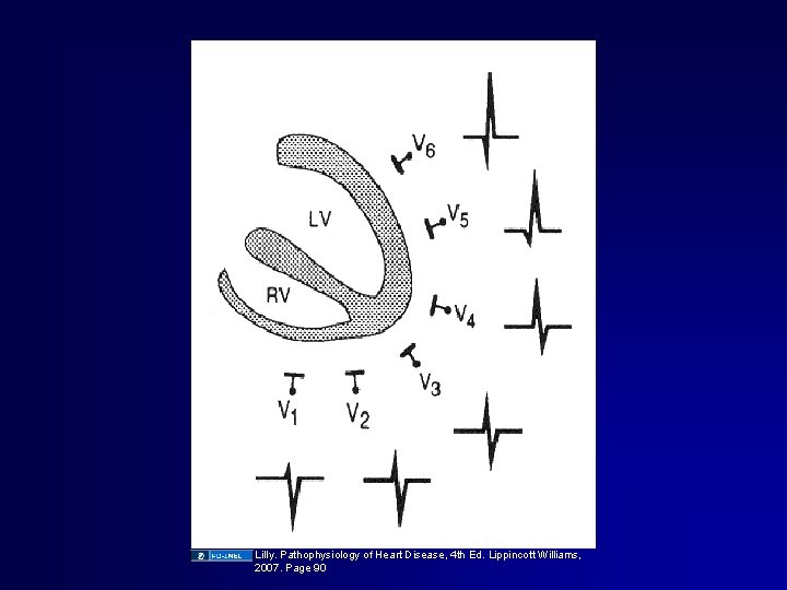 Lilly. Pathophysiology of Heart Disease, 4 th Ed. Lippincott Williams, 2007. Page 90 