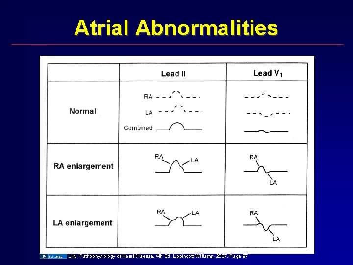 Atrial Abnormalities Lilly. Pathophysiology of Heart Disease, 4 th Ed. Lippincott Williams, 2007. Page