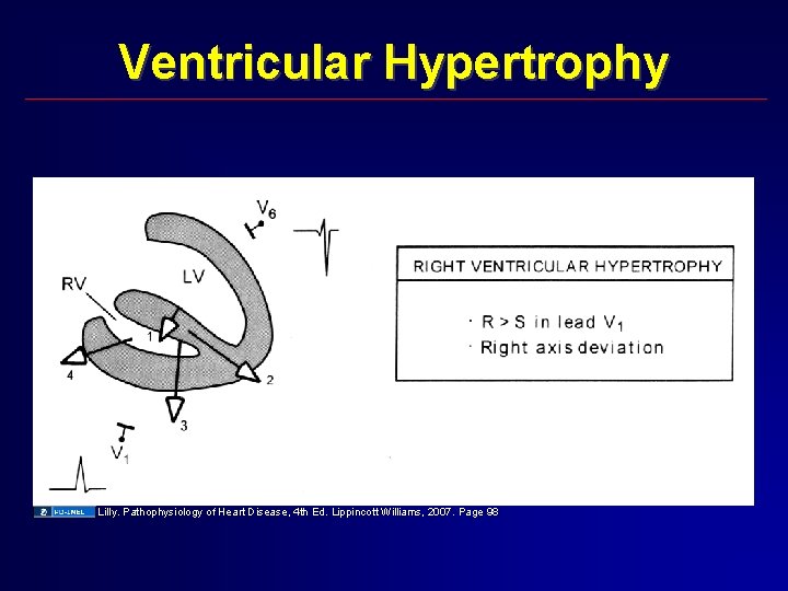 Ventricular Hypertrophy Lilly. Pathophysiology of Heart Disease, 4 th Ed. Lippincott Williams, 2007. Page