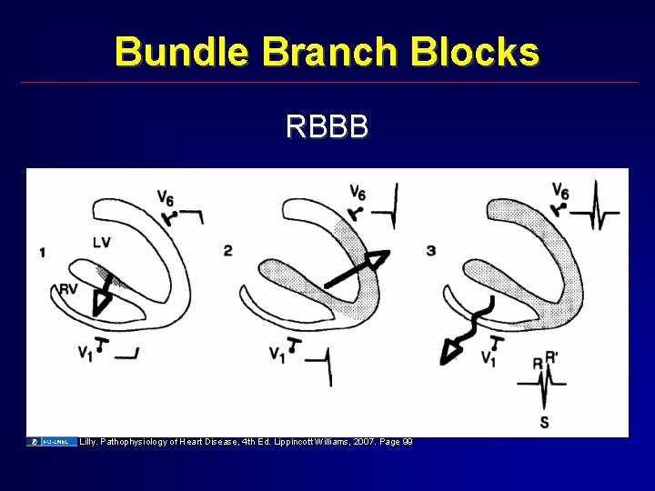 Bundle Branch Blocks RBBB Lilly. Pathophysiology of Heart Disease, 4 th Ed. Lippincott Williams,