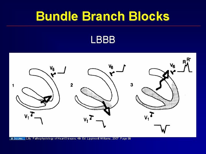 Bundle Branch Blocks LBBB Lilly. Pathophysiology of Heart Disease, 4 th Ed. Lippincott Williams,