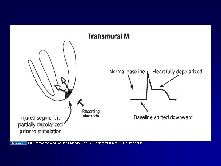 Scan page 88 LILLY (4. 25 transmural) Lilly. Pathophysiology of Heart Disease, 4 th