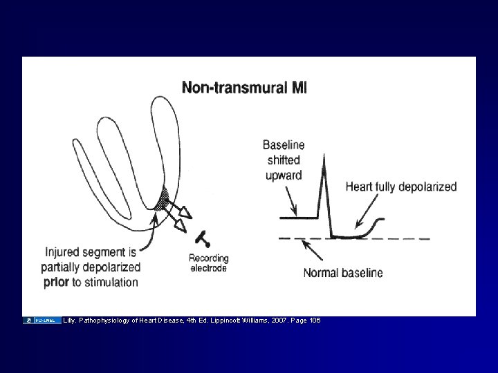 Lilly. Pathophysiology of Heart Disease, 4 th Ed. Lippincott Williams, 2007. Page 106 