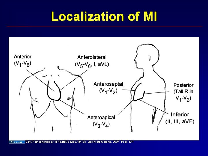 Localization of MI Lilly. Pathophysiology of Heart Disease, 4 th Ed. Lippincott Williams, 2007.