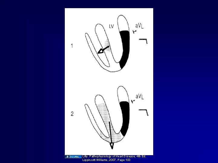 Lilly. Pathophysiology of Heart Disease, 4 th Ed. Lippincott Williams, 2007. Page 103 