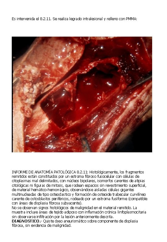 Es intervenida el 8. 2. 11. Se realiza legrado intralesional y relleno con PMMA: