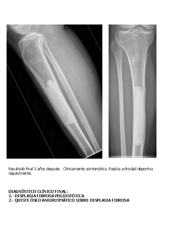 Resultado final 3 años después. Clínicamente asintomática. Realiza actividad deportiva regularmente. DIAGNÓSTICO CLÍNICO FINAL: