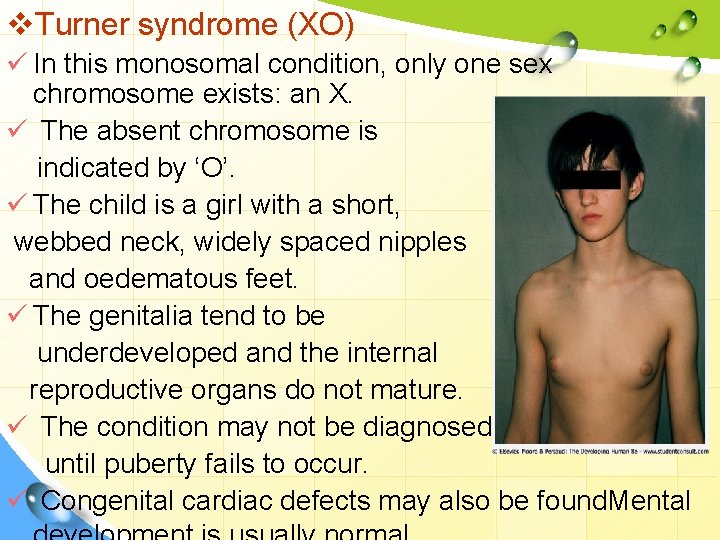 v. Turner syndrome (XO) ü In this monosomal condition, only one sex chromosome exists: