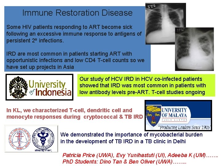 Immune Restoration Disease Some HIV patients responding to ART become sick following an excessive