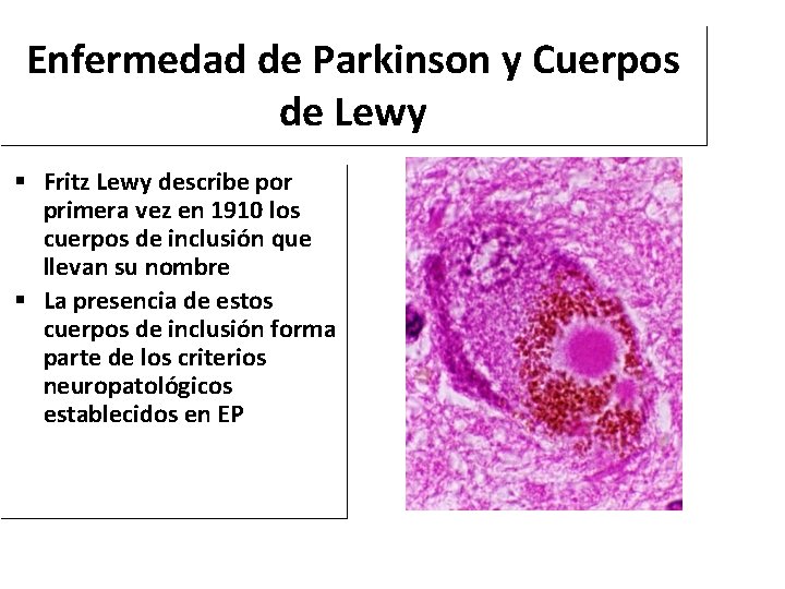 Enfermedad de Parkinson y Cuerpos de Lewy Fritz Lewy describe por primera vez en