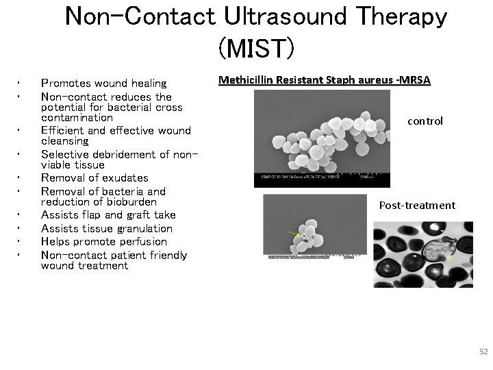 Non-Contact Ultrasound Therapy (MIST) Post Treatment • • • Promotes wound healing Non-contact reduces