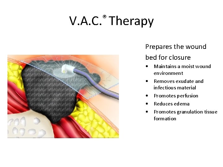 V. A. C. ® Therapy Prepares the wound bed for closure • Maintains a