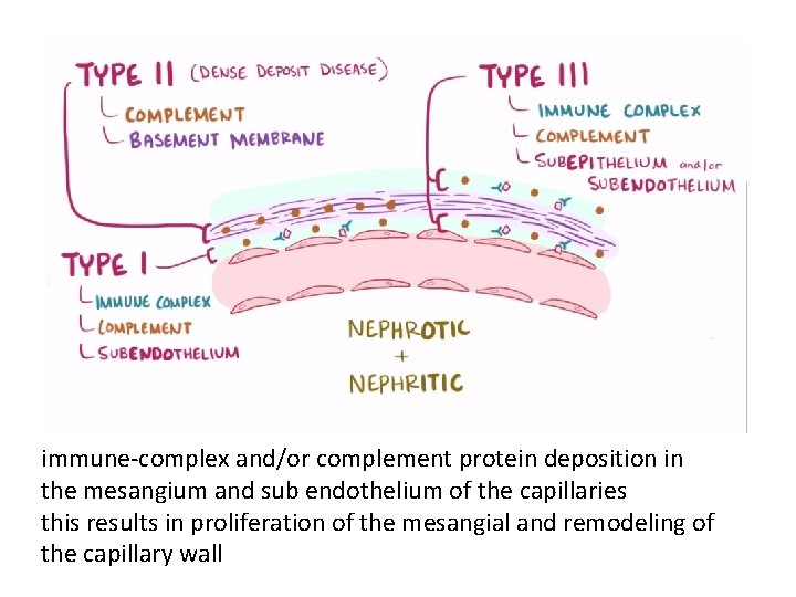 immune-complex and/or complement protein deposition in the mesangium and sub endothelium of the capillaries