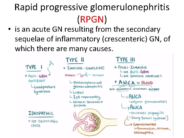 Rapid progressive glomerulonephritis (RPGN) • is an acute GN resulting from the secondary sequelae