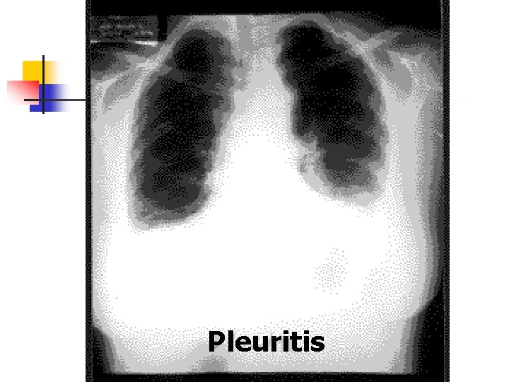 Pleuritis 