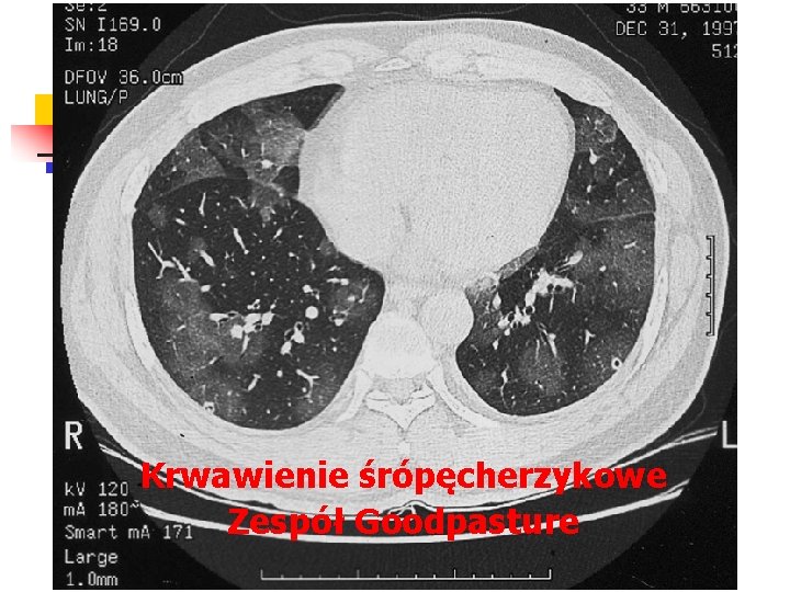 Krwawienie śrópęcherzykowe Zespół Goodpasture 