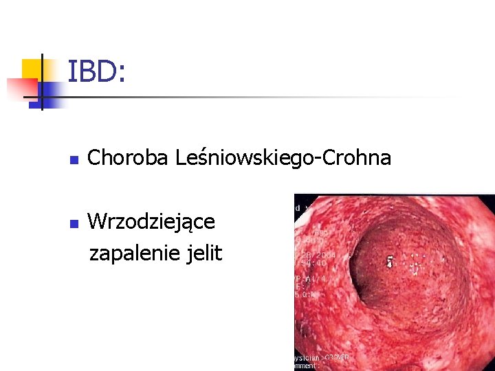 IBD: n n Choroba Leśniowskiego-Crohna Wrzodziejące zapalenie jelit 