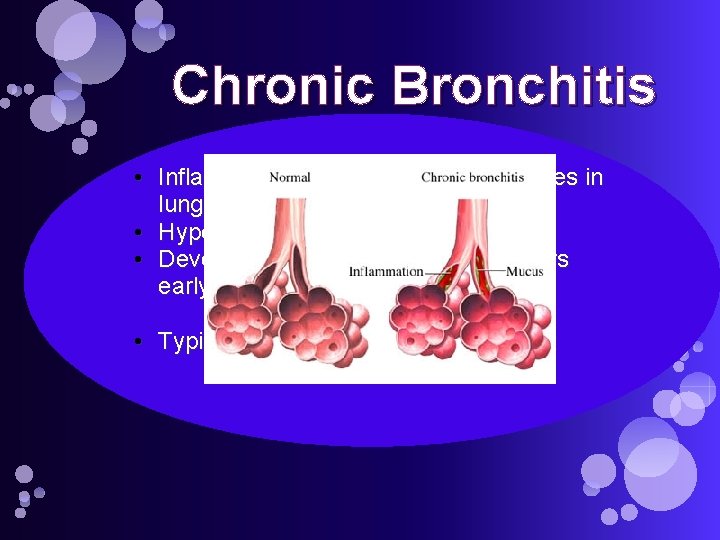 Chronic Bronchitis • Inflammation of bronchi due to changes in lung tissues • Hypoxemia