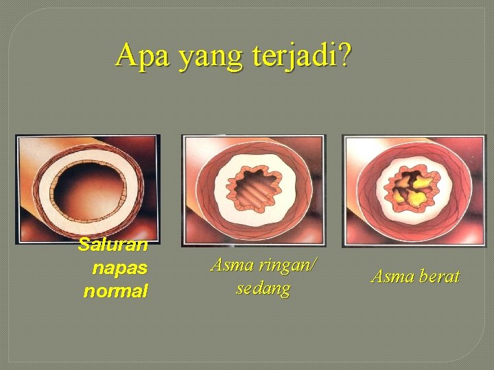 Apa yang terjadi? Saluran napas normal Asma ringan/ sedang Asma berat 