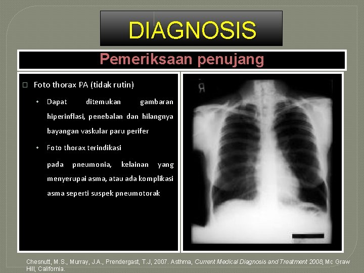 DIAGNOSIS Pemeriksaan penujang � Foto thorax PA (tidak rutin) • Dapat ditemukan gambaran hiperinflasi,