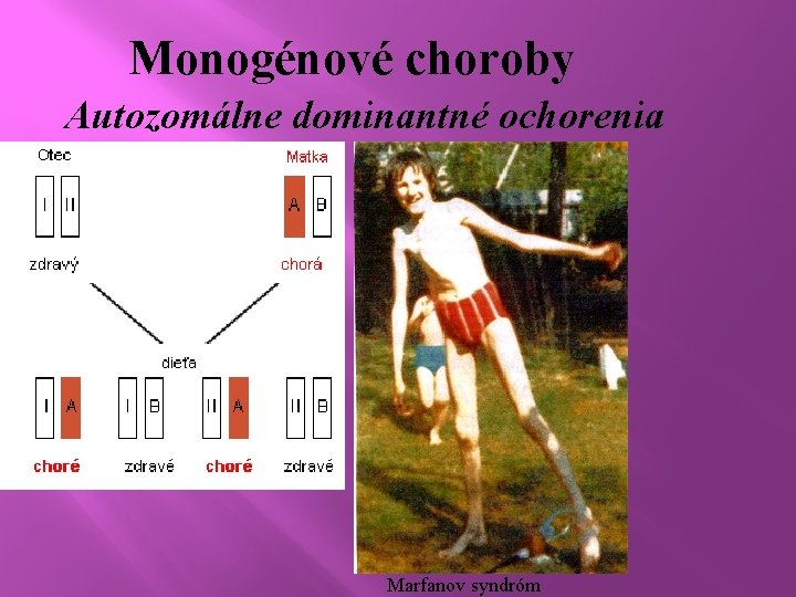 Monogénové choroby Autozomálne dominantné ochorenia Marfanov syndróm 