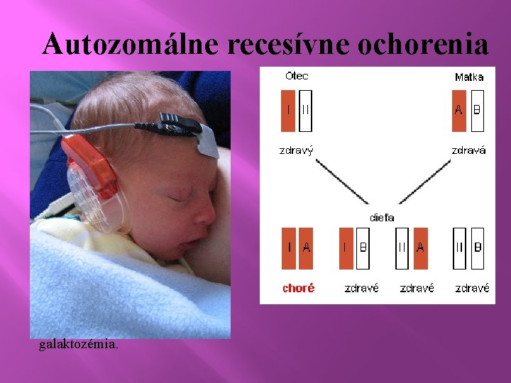 Autozomálne recesívne ochorenia galaktozémia, 