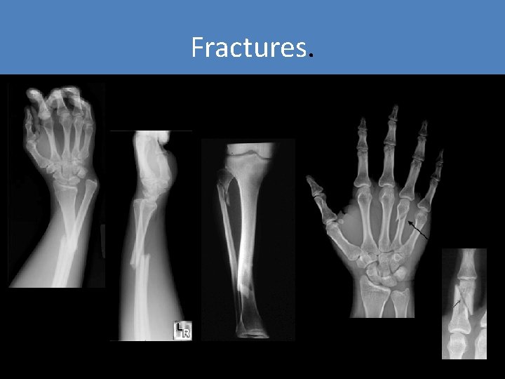 Fractures. Fractures.