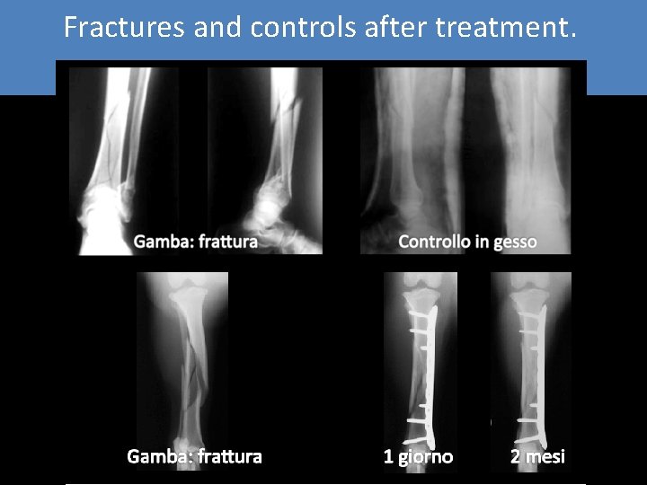 Fractures and controls after treatment. Fractures and controls after treatment.