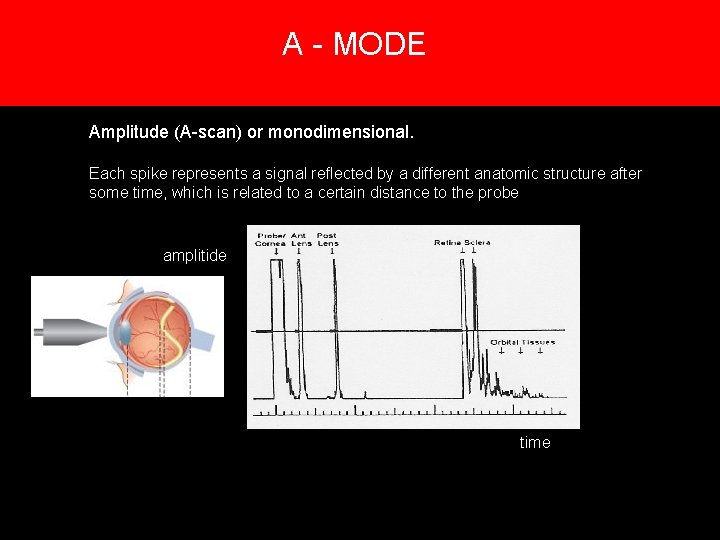 A - MODE 5. Creation of an image Amplitude (A-scan) or monodimensional. Each spike A - MODE 5. Creation of an image Amplitude (A-scan) or monodimensional. Each spike