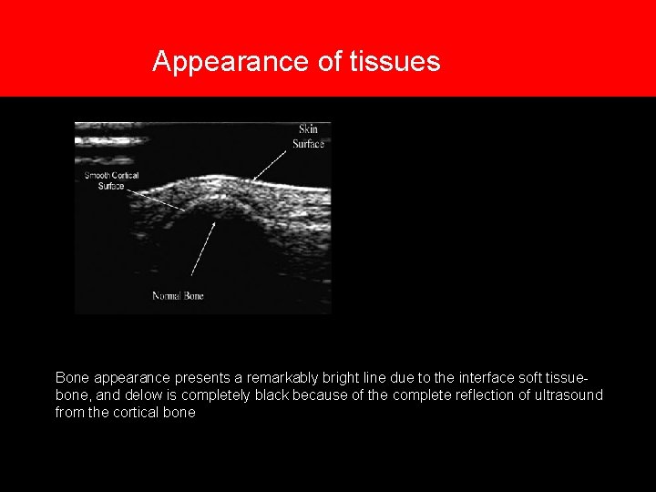 7. Appearance of tissues Bone appearance presents a remarkably bright line due to the 7. Appearance of tissues Bone appearance presents a remarkably bright line due to the