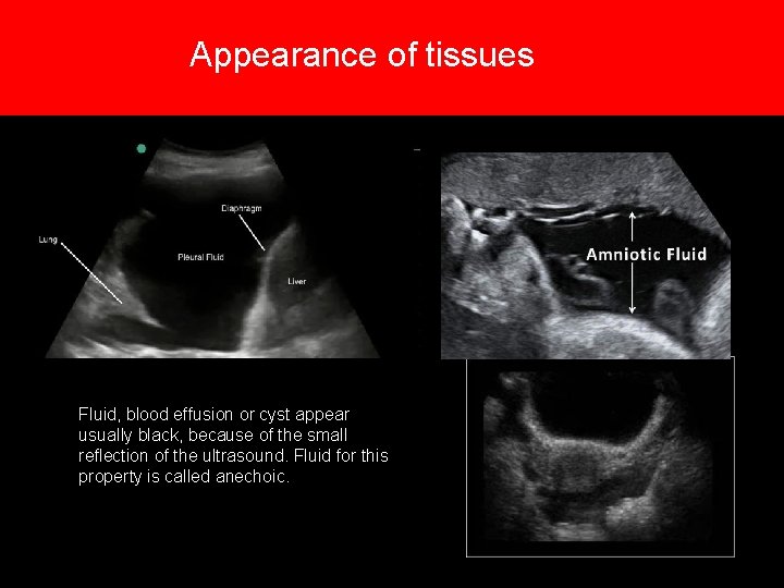 Appearance of tissues 7. Appearance of tissues Fluid, blood effusion or cyst appear usually Appearance of tissues 7. Appearance of tissues Fluid, blood effusion or cyst appear usually